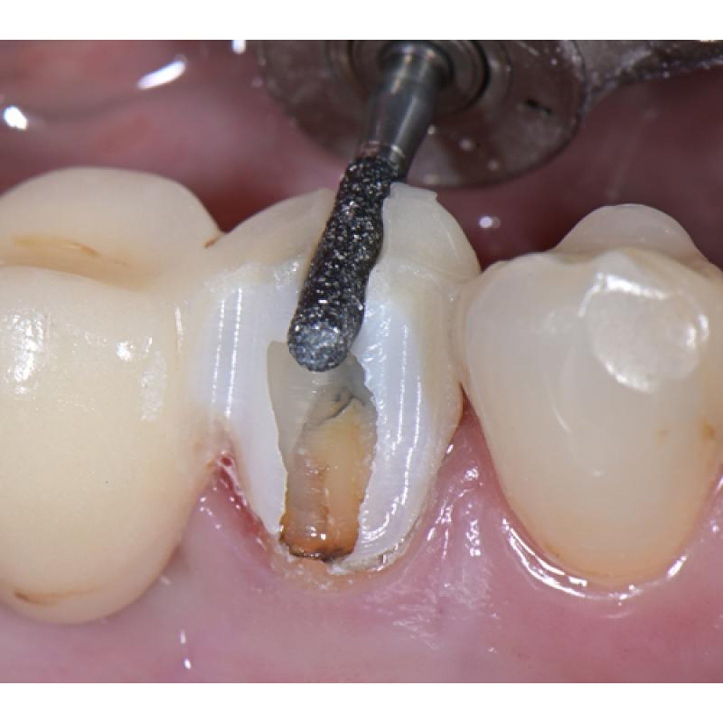 Intensive FG Zircon Cut Prosthetic Set 3 - Diameter: 016
